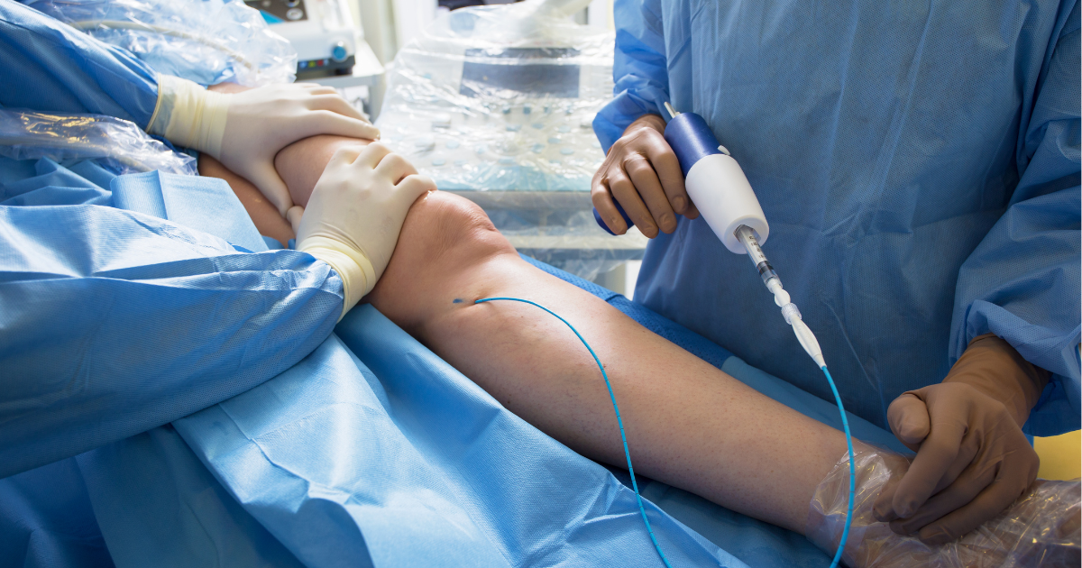 VenaSeal - лечение варикоза без анестезии и компрессии